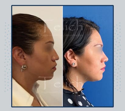 Slider image (8) Dr. Jose E. Telich - Plastic Surgeon